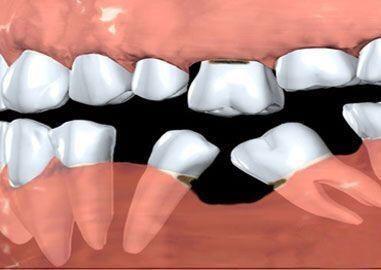 عوارض کشیدن دندانها